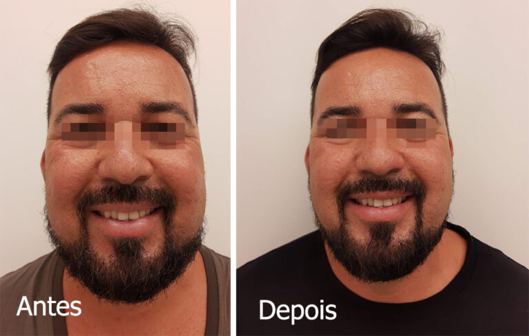 antes depois anailton