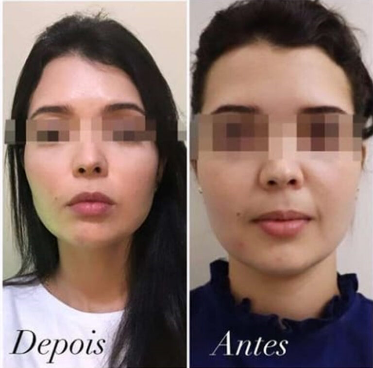antesdepois paula